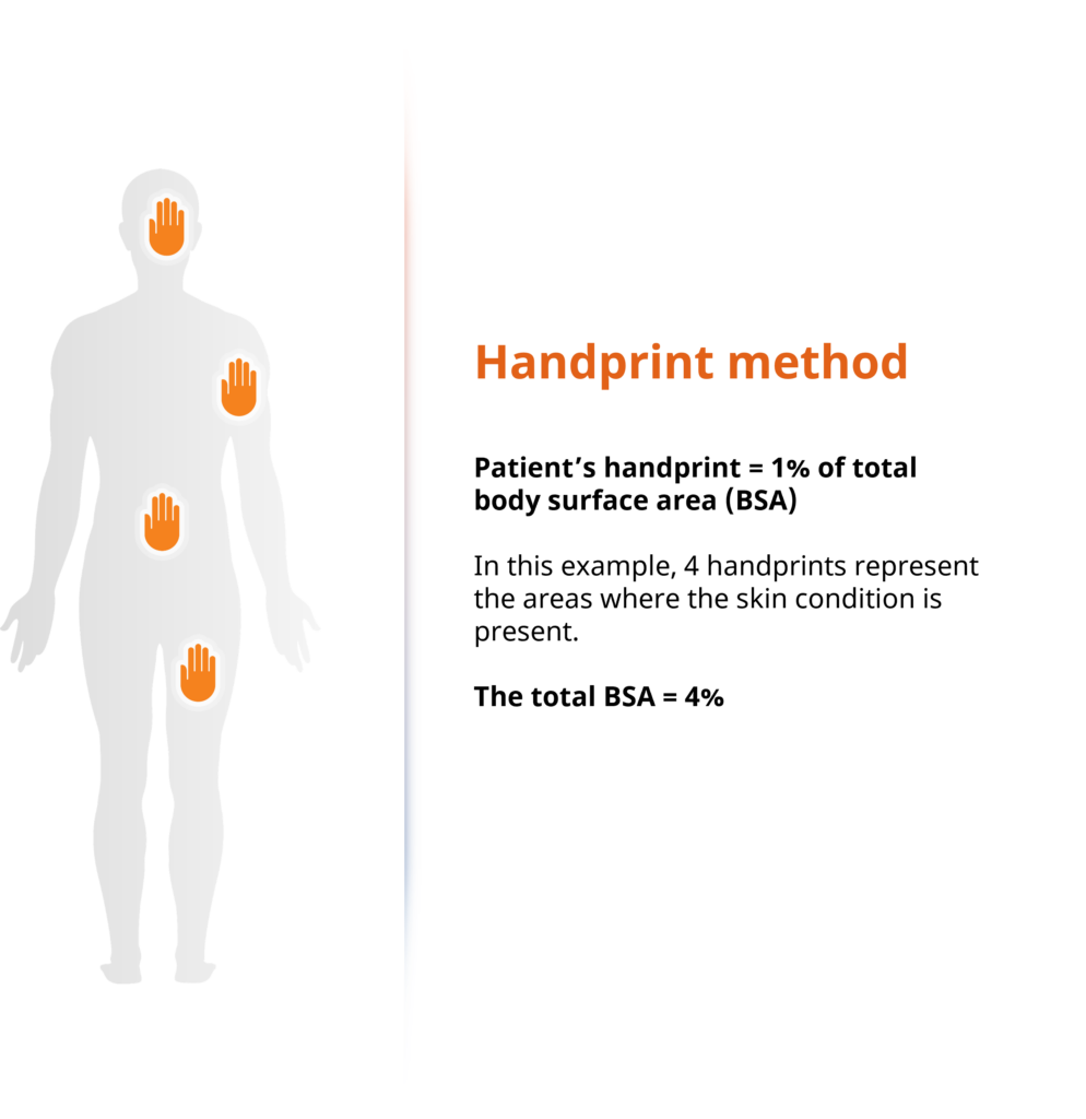 Handprint method assessing atopic dermatitis, 1 Handprint equals 1% of the body surface