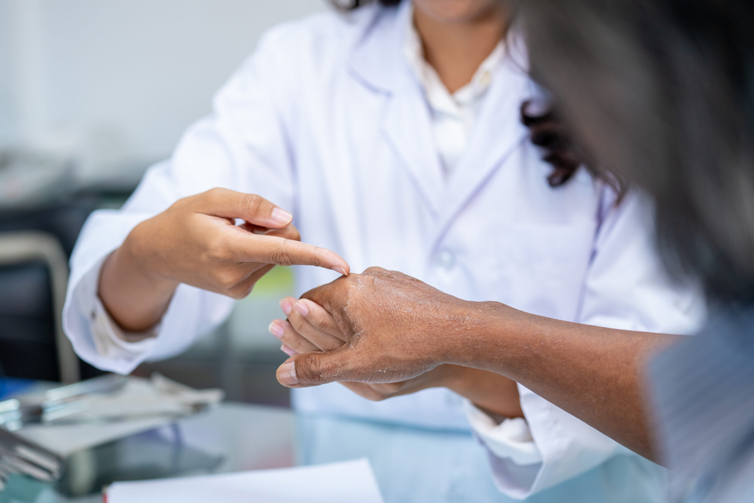 Physician pointing on the hand of a psoriasis patient